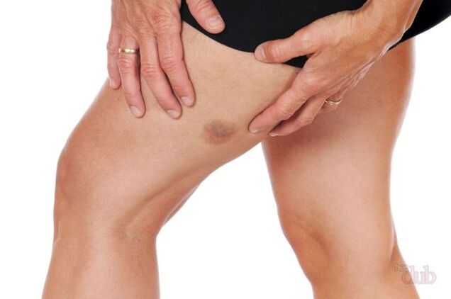 nëse një venë shpërthen