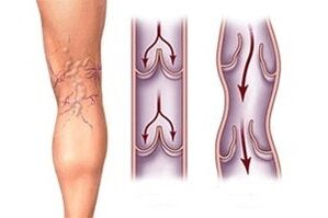 rrjedhja e gjakut në venat me variçe në faza të ndryshme të zhvillimit të sëmundjes